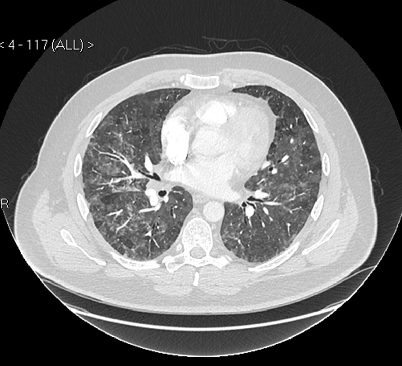 Featherfilled bedding triggered 'lung disease' in a man with allergies